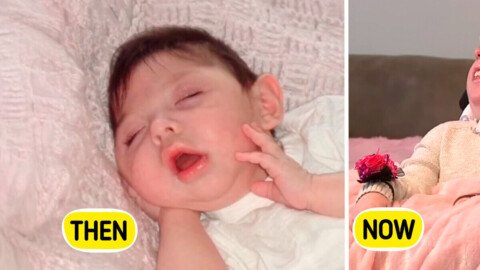 Woman Born Without a Brain Defies the Odds by Celebrating 20th Birthday