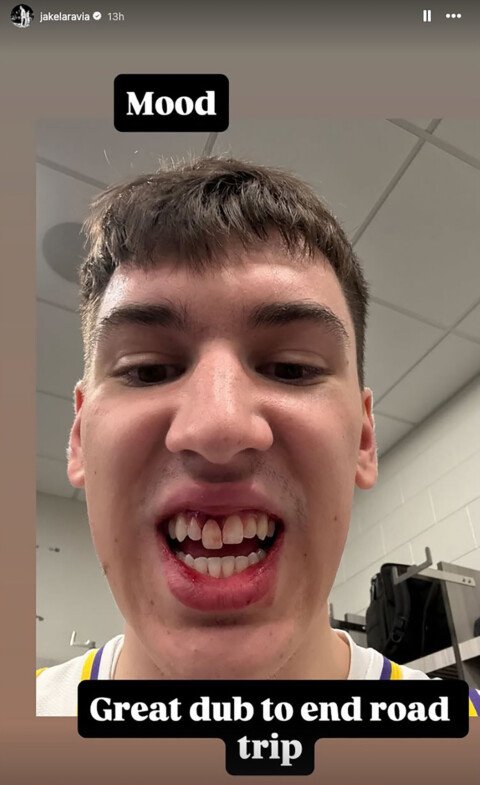 Lakers’ Jake LaRavia shows off gnarly wound suffered during Sixers game