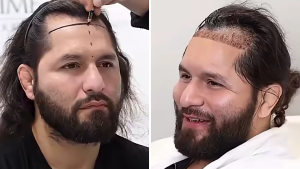 Jorge Masvidal undergoes hair transplant surgery