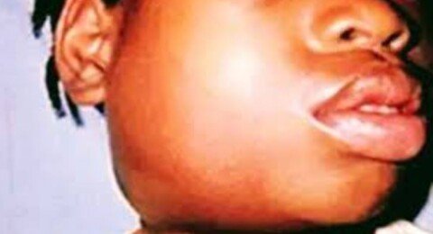 Health Ministry Responds After Mumps Outbreak Concerns in Nairobi Schools