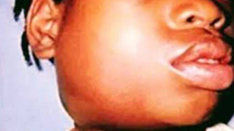 Health Ministry Responds After Mumps Outbreak Concerns in Nairobi Schools