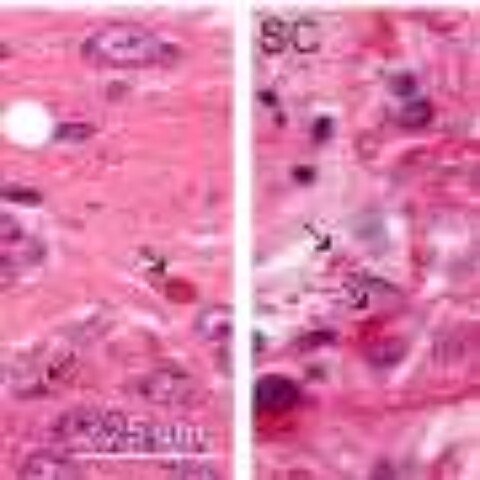 First drug to treat Alexander disease approved by the FDA after three decades of research