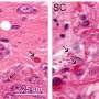 First drug to treat Alexander disease approved by the FDA after three decades of research